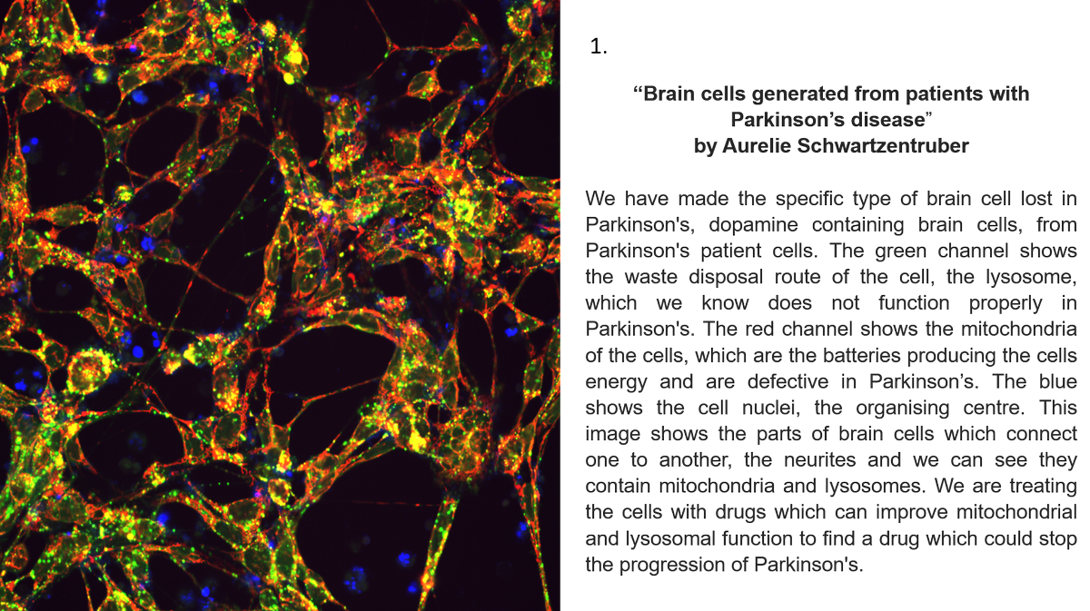 Picture 1 by Aurelie Research Tech <a href="/ParkinsonsUK/">Parkinson's UK</a> <a href="/HeatherMortiboy/">Prof Heather Mortiboys</a> Vote for Aurelie's image #Parkinsons patient neurons <a href="/PerkinElmer/">PerkinElmer</a> RTplease