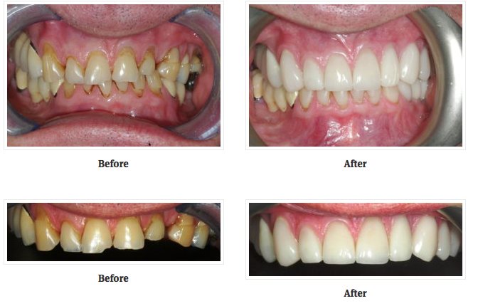 StoneRockKent's tweet photo. A wonderful result for this patient by Russell Blanchard, using veneers and crowns to create a beautiful smile.
https://t.co/7dSiu60Fat https://t.co/LduxtHoK6R