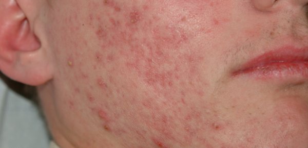 FOXOF_SANTE's tweet photo. #Mednovis #Davita

Le traitement des maladies de peau avec la thérapie par la lumière
  
• L'#acné vulgaris

https://t.co/XoFx2tmQZ1 https://t.co/sPYZih4222