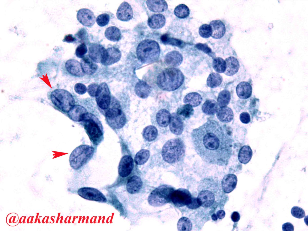 aakasharmand's tweet photo. B9 not AUS  Thyr cyst FNA react-chang &amp; intranuc-grooves,  @marcoslepe @marenwhymd @ENTpathology @EMadrigalDO @Sara_Jiang @PennPathLabMed https://t.co/6lILhnbylP