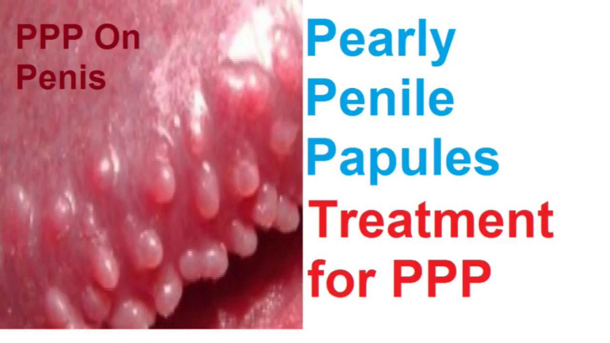 Pearly Penile Papules Laser Treatment, Not worth it. http