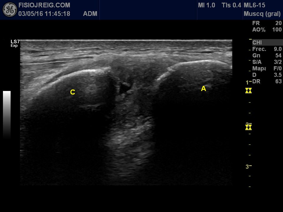 jordireigfisio's tweet photo. Subluxacion clavícula, valorar con #Ecografia separación extremos, edema y desgarro ligamento acromioclavicular @fisiojreig #formacion https://t.co/B9HEymkTZM