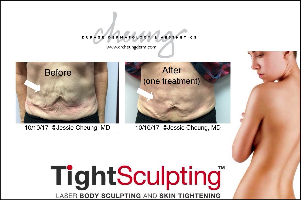 fotona tightsculpting near me