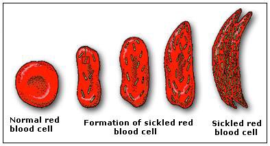 C311W411's tweet photo. sickle cell amenia is where deformed cytoskeletons disrupt the circulation of red blood cells! don't trust @cytoformio ! #MIO17 https://t.co/S92tFv68YC