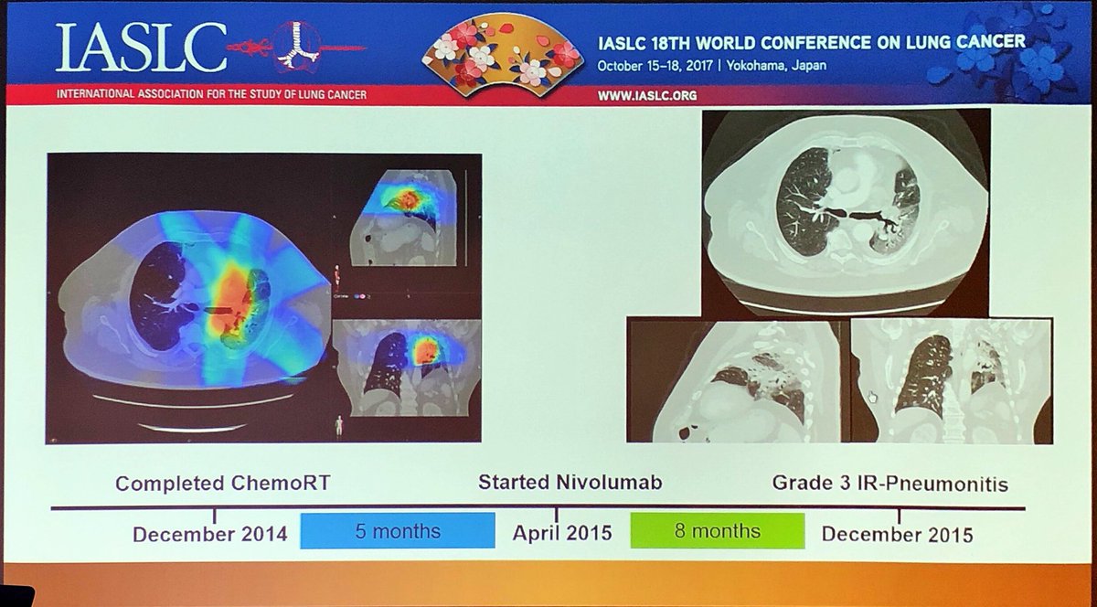 _ShankarSiva's tweet photo. Real-world pneumonitis data with #Immunotherapy - higher rates (19%) than in trials, but no diff. in risk with prior chest RT #WCLC2017 https://t.co/yMQLqCGaIJ