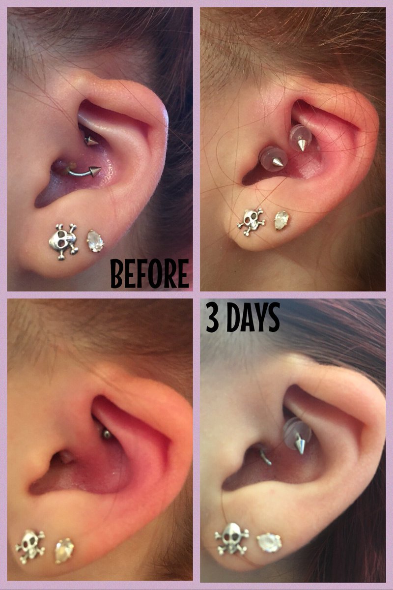 Check out the amazing results of our LobeLove™ Healing Discs. If you have hypertrophic scarring grab a set today &amp; see results within days!