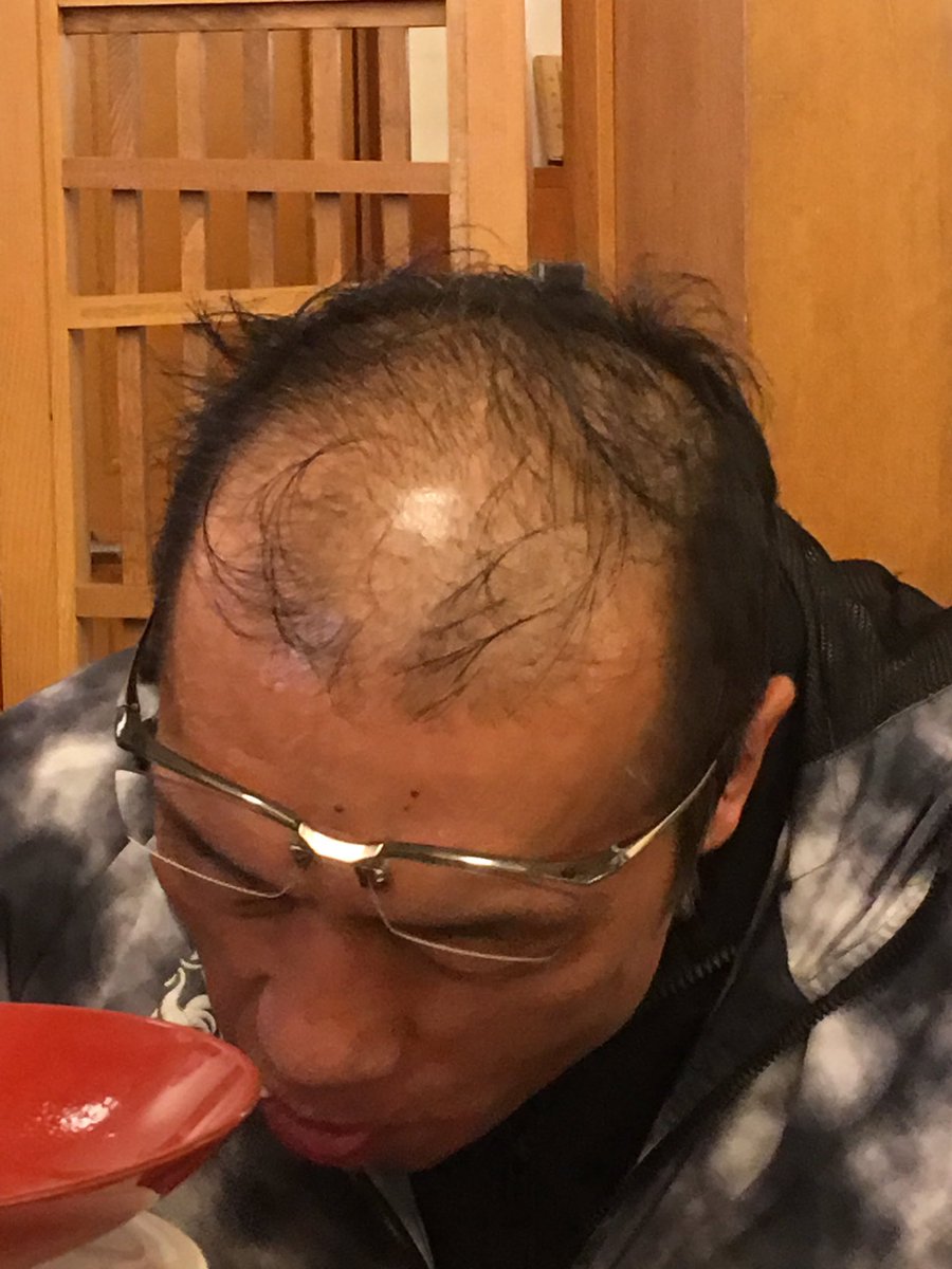 壁下 陽一 センバツ甲子園クリーニング絶賛受付中 米国直輸入の育毛剤を朝晩塗りたくり 出かける時はジェルで固めるのがシュワルツ流 少ない前髪を無理にジェルで固めるのでバッタの触角みたいなものです あ トリートメントもしてるみたい 潤いが違う