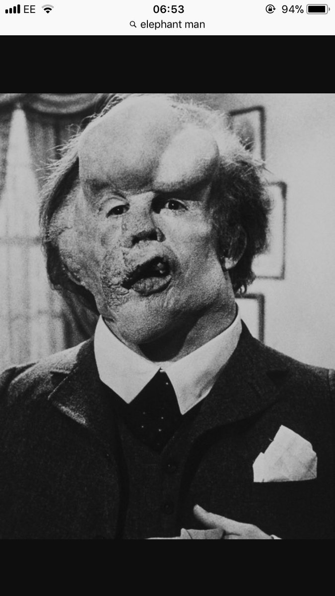 Bek_Mellor's tweet photo. Day 4 of feeling poorly 😫 now my eye has swollen and I’m beginning to look like elephant man https://t.co/NkkEQvp9o3