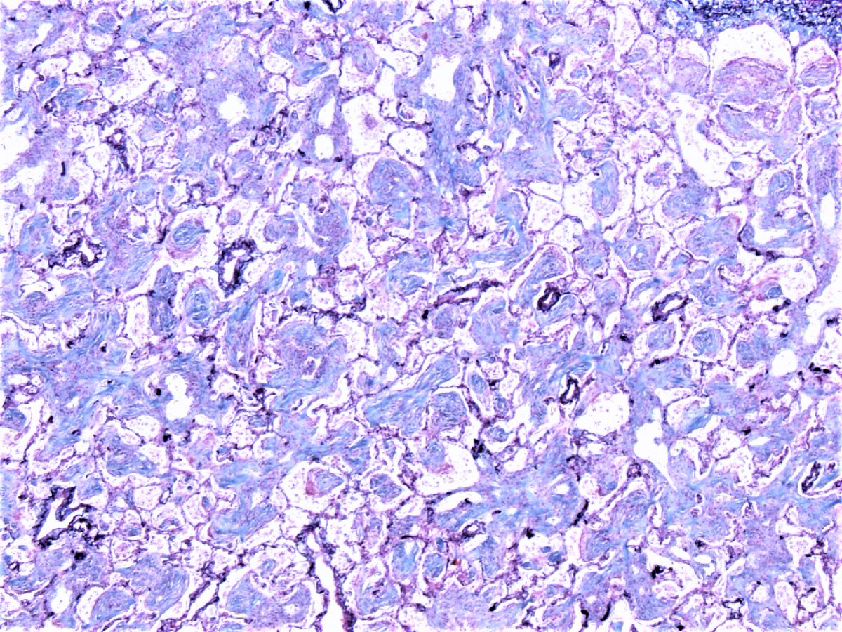 Patholwalker's tweet photo. Organizing pneumonia, most likely induced by antiarrhythmic agent. Lung, autopsy. HE and Masson-Trichrome. https://t.co/zpQaBoC5Fy