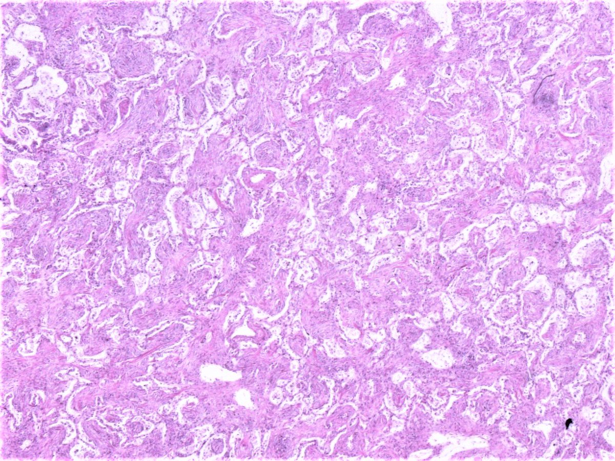 Patholwalker's tweet photo. Organizing pneumonia, most likely induced by antiarrhythmic agent. Lung, autopsy. HE and Masson-Trichrome. https://t.co/zpQaBoC5Fy