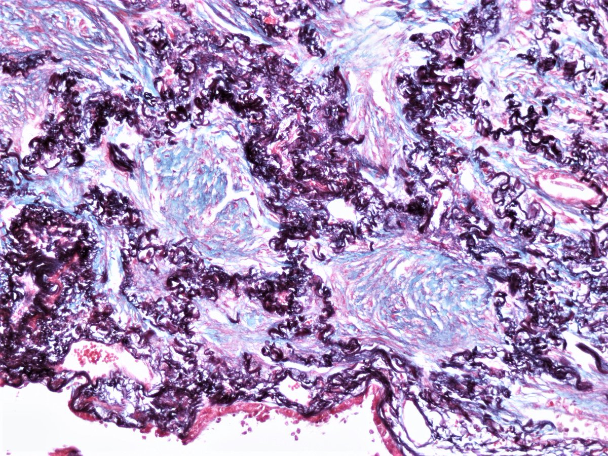 Patholwalker's tweet photo. Organizing pneumonia, most likely induced by antiarrhythmic agent. Lung, autopsy. HE and Masson-Trichrome. https://t.co/zpQaBoC5Fy