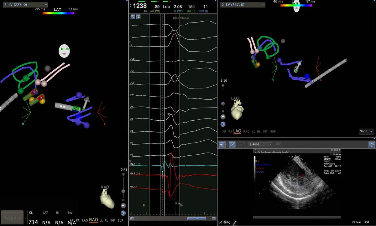 AL-PM PVC today.  Switching access from retrograde to TS made it a success! <a href="/narrowQRS/">JMC</a>
