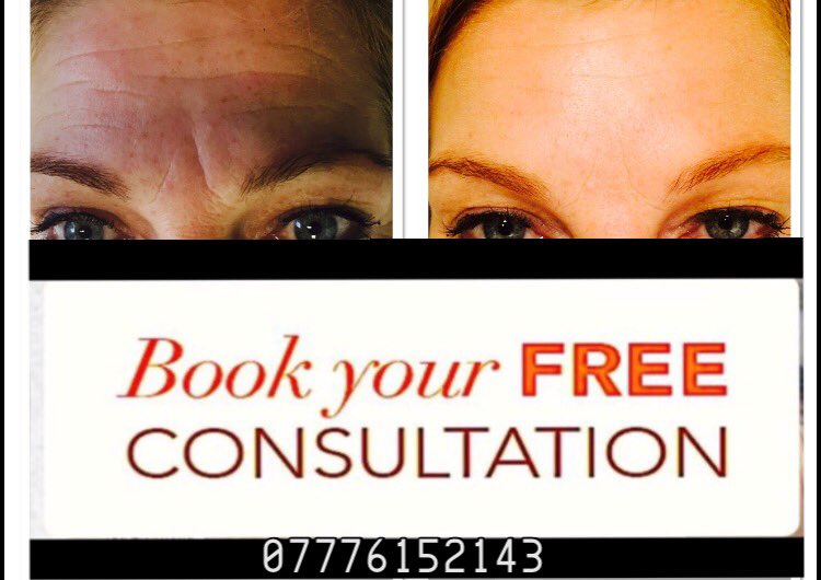 FinesseLeeds's tweet photo. Soften those harsh frown lines ladies and gentlemen #antiwrinkleinjections  #leedsclinic #nurse #freeconsultation  #aesthetics #fillers https://t.co/aKnL5QPEON