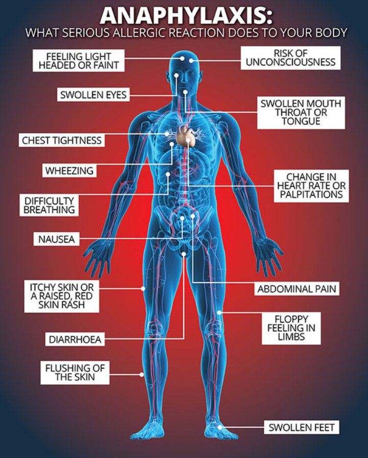 NerdKid_94's tweet photo. In Anaphylaxis, the swelling is so severe that even the airway is involved. This causes the airway to be blocked and it can be FATAL. https://t.co/PmImbY5OVz