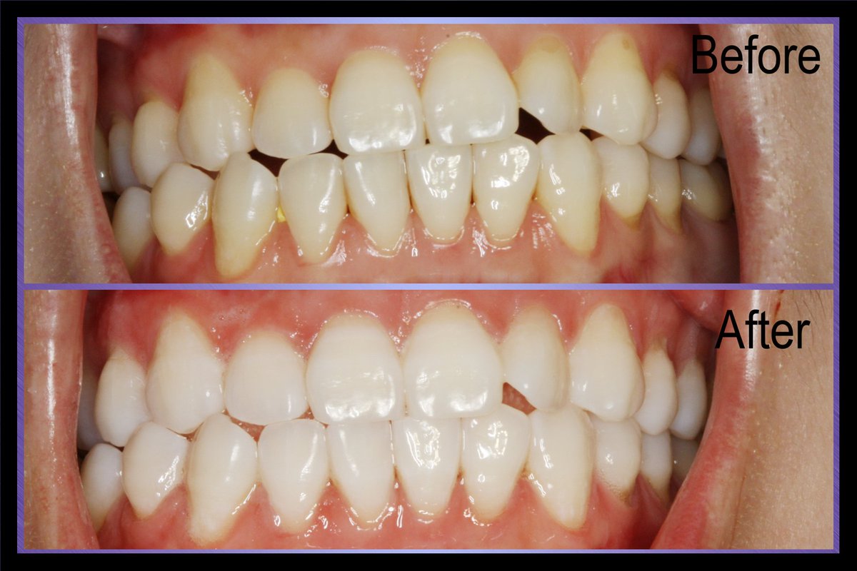 ✨One of our PTs has made the decision to get ZOOM* &amp; the results for that came out GREAT! GET READY FOR THE HOLIDAYS!🎁#LoveYourSmile