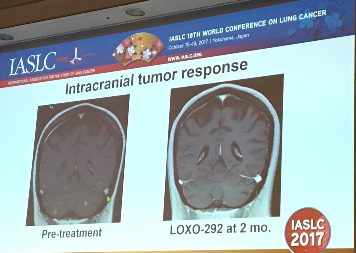 LOXO292 highly selective RETinhibitor. Well tolerated with promising intracranisl efficacy
