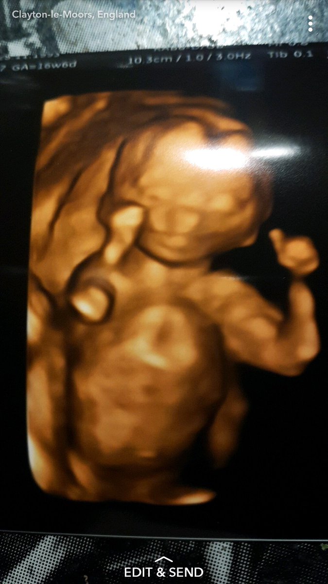 linzcatlow's tweet photo. When you can’t stop looking at your granddaughters scan picture #granddaughter #loveherallready #nana #baby #scanpic #cutie https://t.co/a9B7DYBGJz