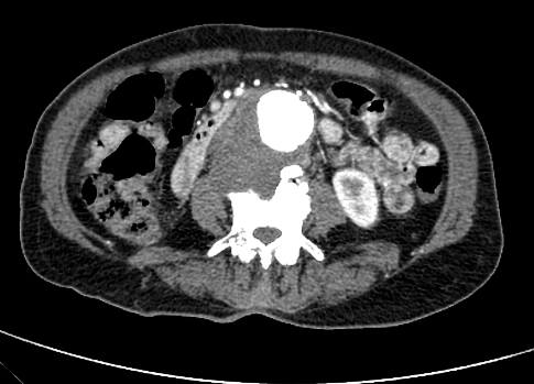 RadiologySigns's tweet photo. Q: The D***** aorta sign? ANSWER: https://t.co/kiQGU5Jvwo #FOAMrad #FOAMed https://t.co/l6N7kN3XLp