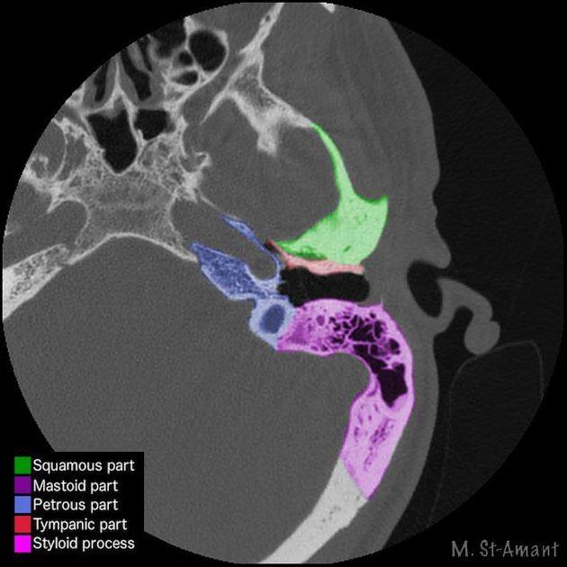 Radiology Signs on Twitter: "Q: Do you know your temporal bone anatomy