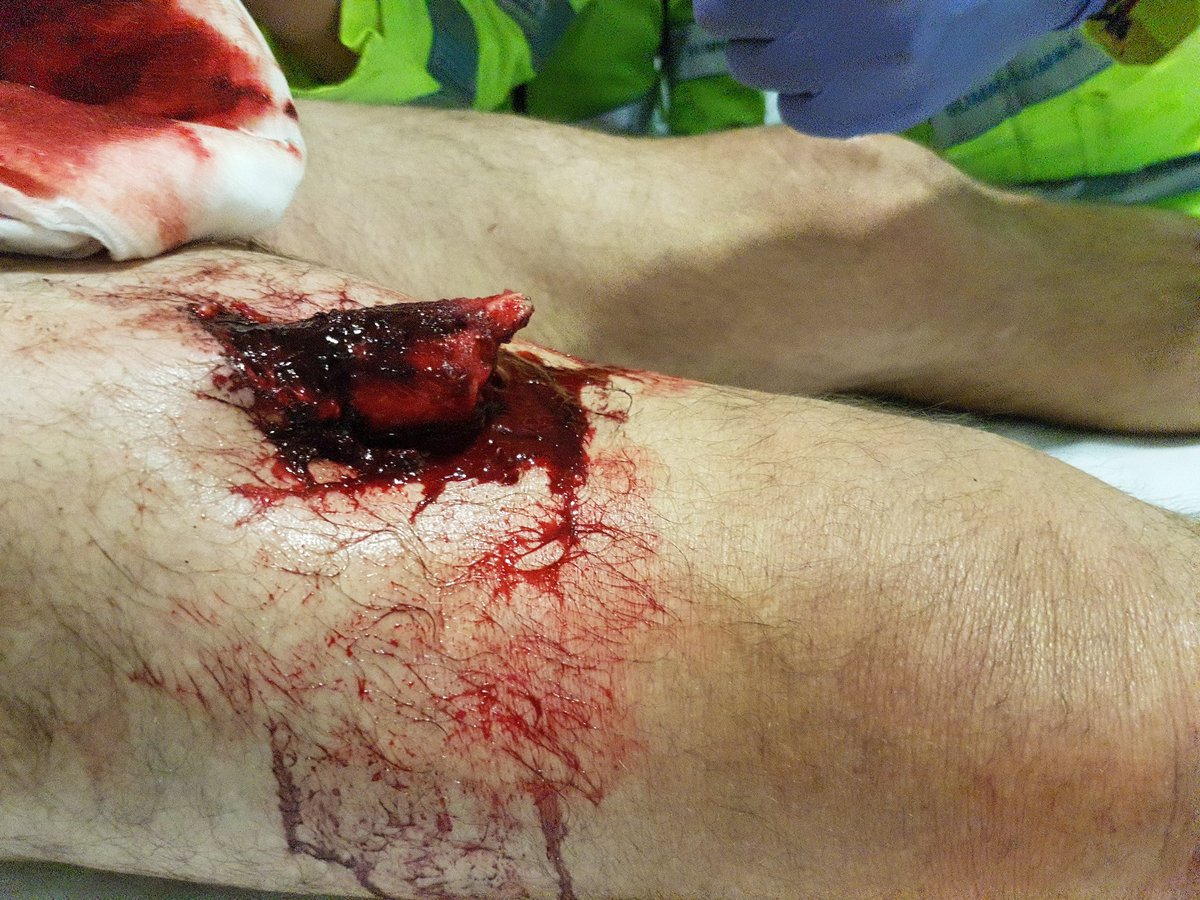 drfelipejimenez's tweet image. Tráfico, motocicleta contra camioneta fx abierta de fémur. Vir 03 con la ayuda de ambulancia de valdemoro @pablobusca