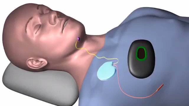 Neuromodulation to Treat Obstructive Sleep Apnea ile ilgili görsel sonucu