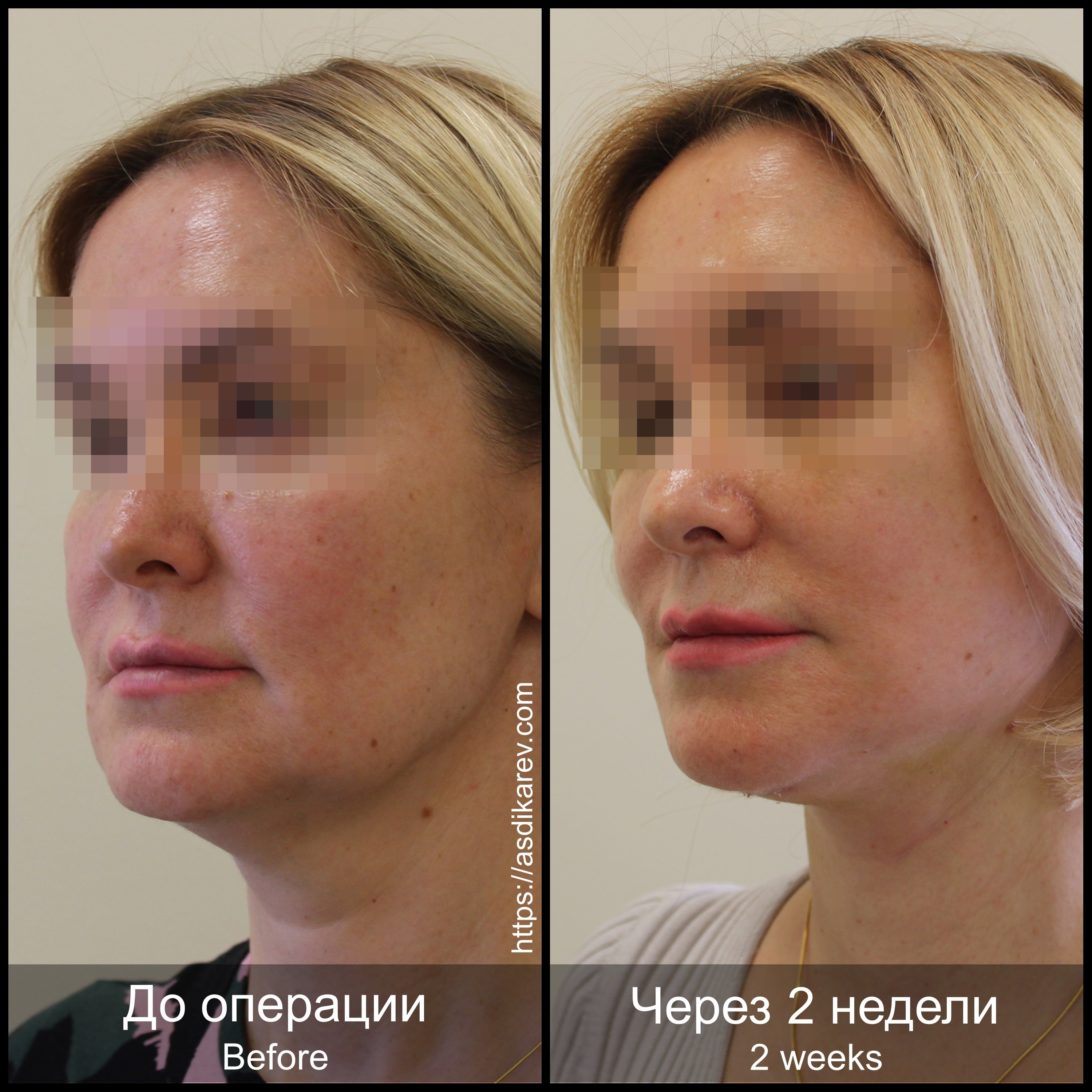 Шрамы после подтяжки средней зоны лица