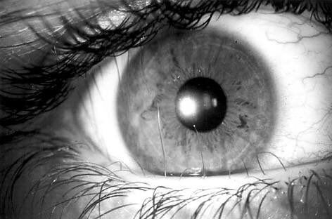 CyprusSusan's tweet photo. صفين من الرموش وليس صف واحد إسم المرض #Distichiasis؛ السبب وراثي أو غير وراثي الرموش تلامس العين فتؤثر على الرؤية وتسبب أمراض بملتحمة العين. https://t.co/fRpEN9aAwc