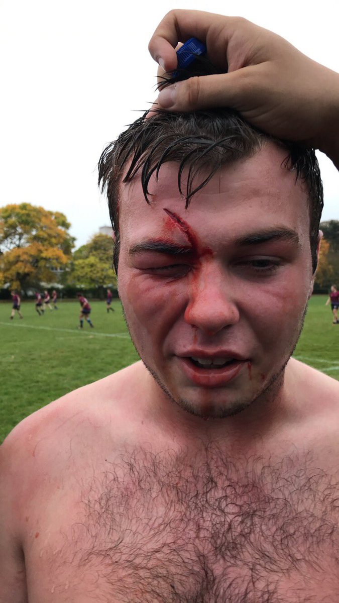 UoNRugbyLeague's tweet photo. Laurence is off with a stud to the head #Gremlins #gremlinsrl #uon https://t.co/c137y6TxQv