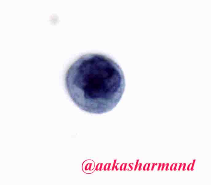 aakasharmand's tweet photo. When cells read atlas - HSIL @marcoslepe @marenwhymd @EMadrigalDO @Sara_Jiang @edusqo @sam_albadri @PennPathLabMed @JMGardnerMD @JL_Sauter https://t.co/mgICcD0Nmq