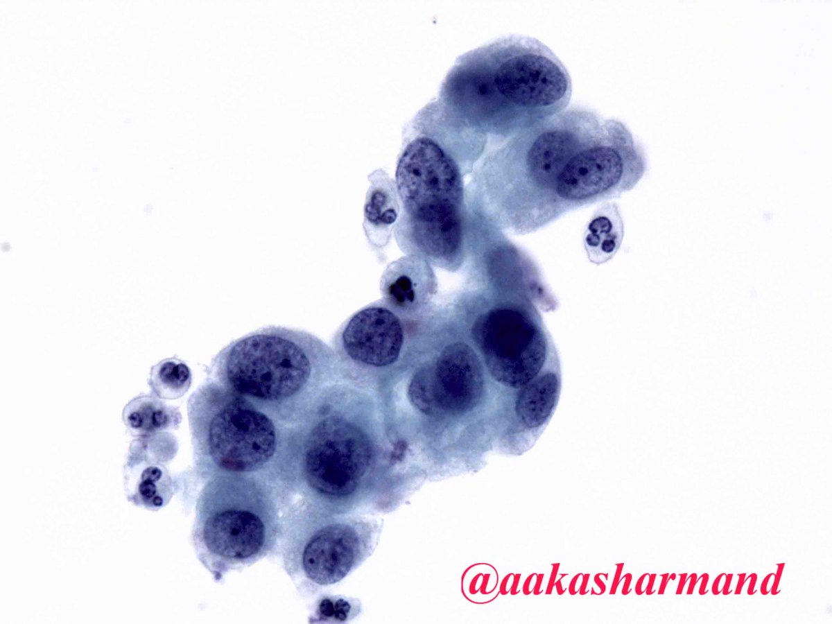 aakasharmand's tweet photo. When cells read atlas - HSIL @marcoslepe @marenwhymd @EMadrigalDO @Sara_Jiang @edusqo @sam_albadri @PennPathLabMed @JMGardnerMD @JL_Sauter https://t.co/mgICcD0Nmq