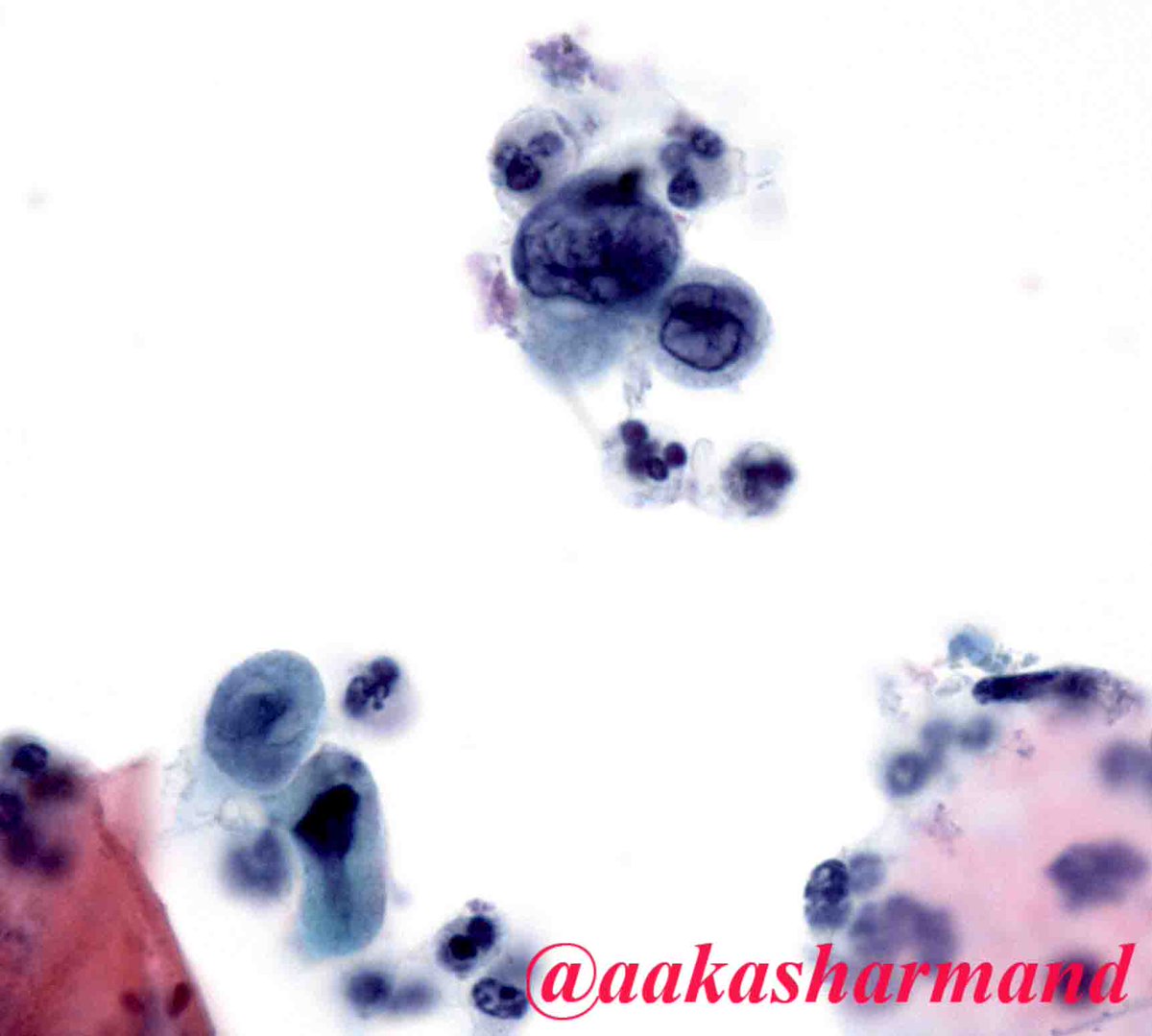 aakasharmand's tweet photo. When cells read atlas - HSIL @marcoslepe @marenwhymd @EMadrigalDO @Sara_Jiang @edusqo @sam_albadri @PennPathLabMed @JMGardnerMD @JL_Sauter https://t.co/mgICcD0Nmq