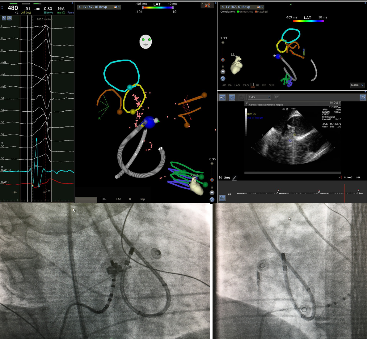 Got this one today from below the RCC. F curve helped me get better contact.