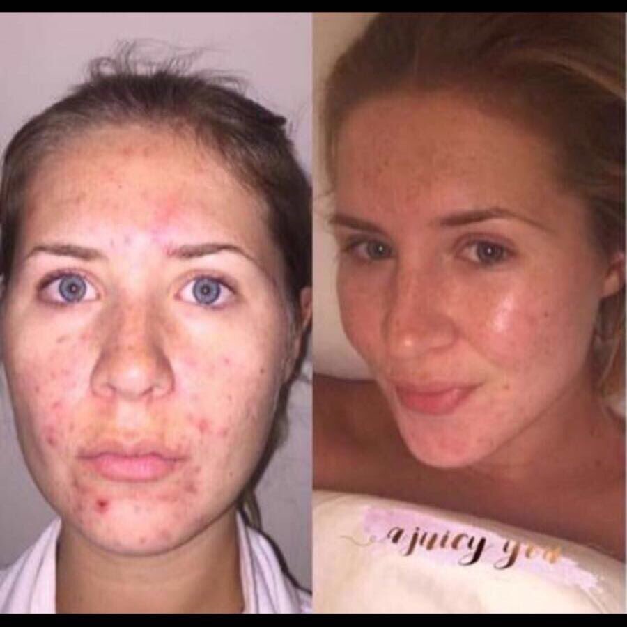 AdeleGambling's tweet photo. Wow 😳 
Gorgeous glowing skin 💜

Using our Organic Berry Blend Capsules 🍓🍇
Packed full of antioxidants which are AMAZING for your #SKIN 😍👏🏼 https://t.co/cIPVmWjOQA
