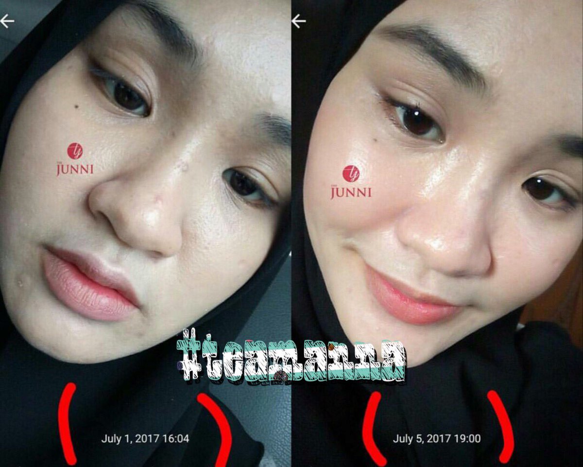 agentthejunnijb's tweet photo. Before 1 JULY 2017 &amp; After 5 JULY 2017 

Wow gituwww😍😍flawless tak??nk tak mcm ni?kalau nk meh Pm💁🏼 rugi kalau tk brtindak skrg✌🏻 https://t.co/IyXIOCWSTK