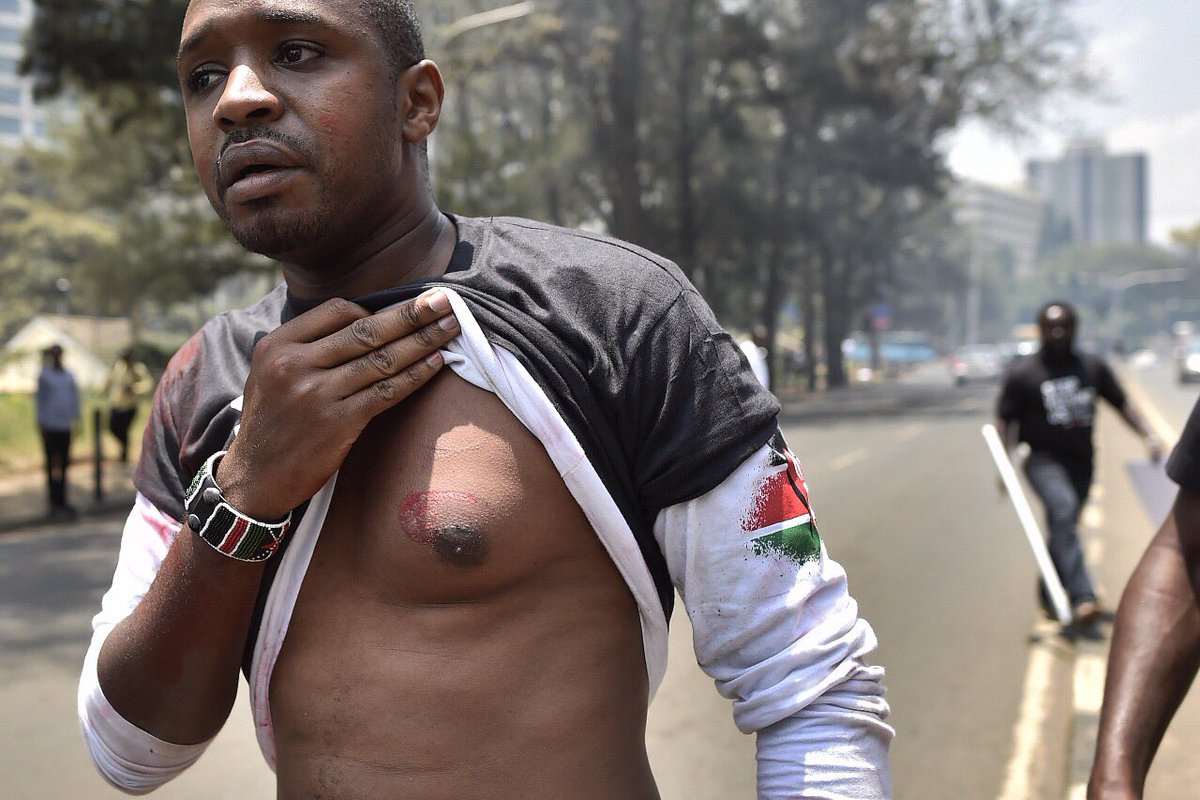 bonifacemwangi's tweet photo. I have been treated at Kenyatta Hospital. X-ray done,nothing broken. Just a hematoma (a solid swelling of clotted blood within the tissues) https://t.co/CP8StVNYEb
