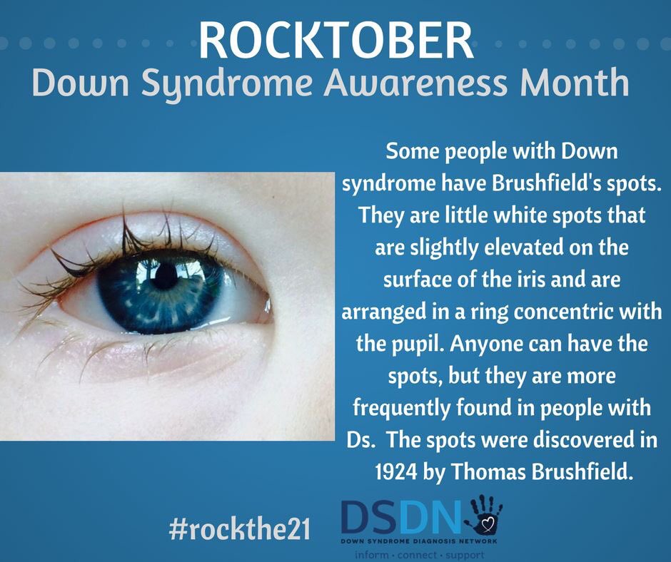 TheDSDN's tweet photo. Does your child have Brushfield's spots? #DownSyndrome #DSDN #DSAM17 https://t.co/H9ri3bQI10