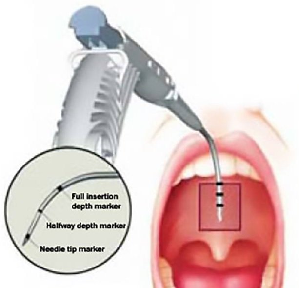 PillarDistribut's tweet image. The Pillar Procedure is performed under local anesthesia &amp;amp; completed in roughly 20 minutes. #dentistry #dental #sleep #snoring #sleepapnea