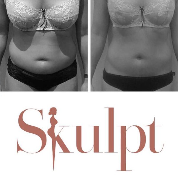 Here is an amazing before and after comparison following our Clatuu fat freezing treatment 😍👏🏽 Call 01565745680 to book your consultation
