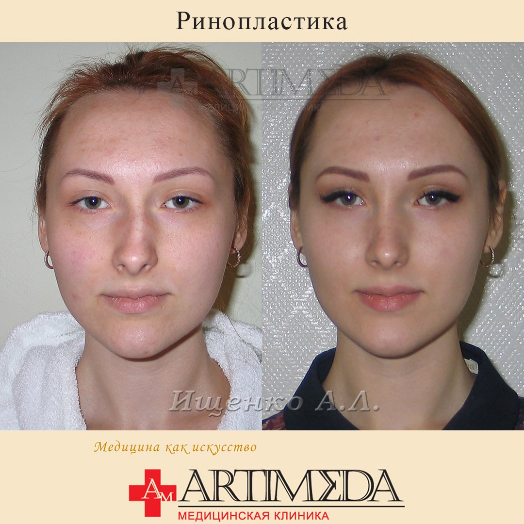 Лада эстет отопластика