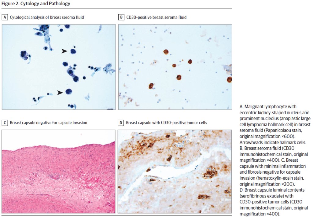 JAMASurgery's tweet photo. Systematic #Review: #BreastImplant associated anaplastic large cell #lymphoma https://t.co/JHpDgeywSI https://t.co/vdF1UrZRAe
