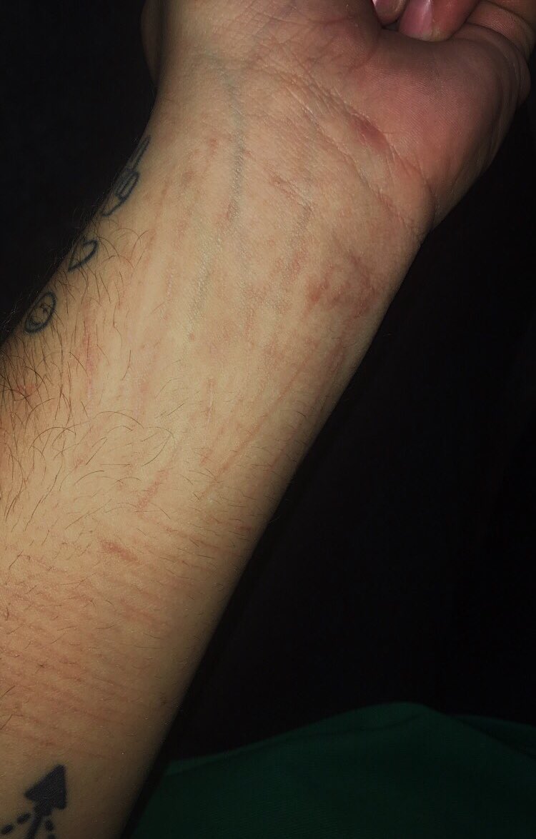 cayaliesemusic's tweet photo. no more blood. my heart is healed. there are scars, but I have come so far. #SuicideAwareness #SelfHarmAwareness #Recovery #HealedHearts https://t.co/QOmXoAtDmc