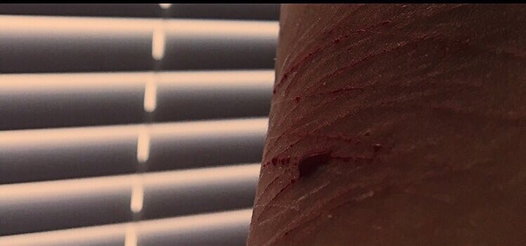 cayaliesemusic's tweet photo. no more blood. my heart is healed. there are scars, but I have come so far. #SuicideAwareness #SelfHarmAwareness #Recovery #HealedHearts https://t.co/QOmXoAtDmc
