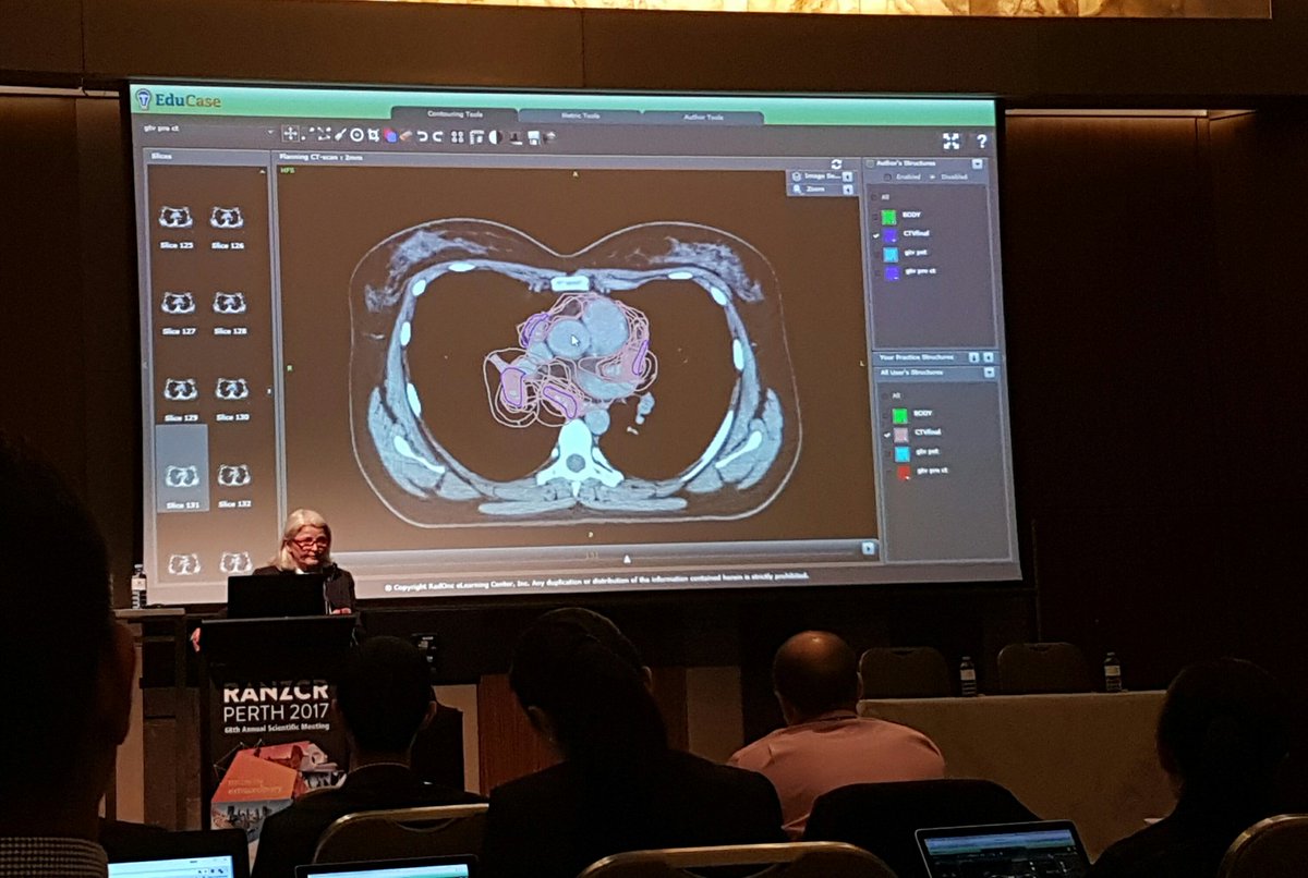 Carisc_'s tweet photo. Lymphoma contouring workshop.  Keeping the CTV tight in IFRT. #RANZCR2017 @Hendo_tan @JessDortmans https://t.co/z351k0bcdq