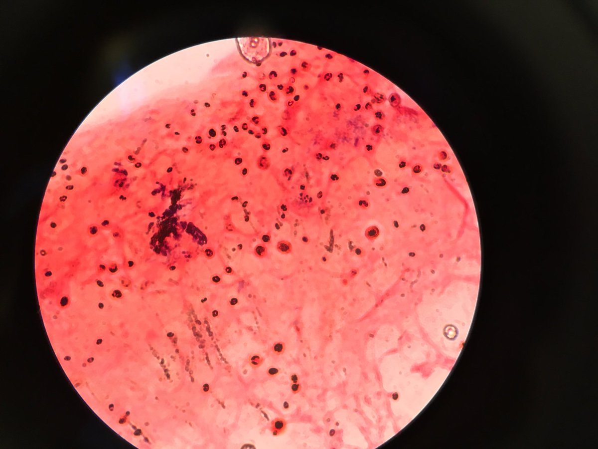 tecitoleiva's tweet photo. Levaduras capsuladas en Gram de LCR #microbiology https://t.co/8Sy3hehJyJ