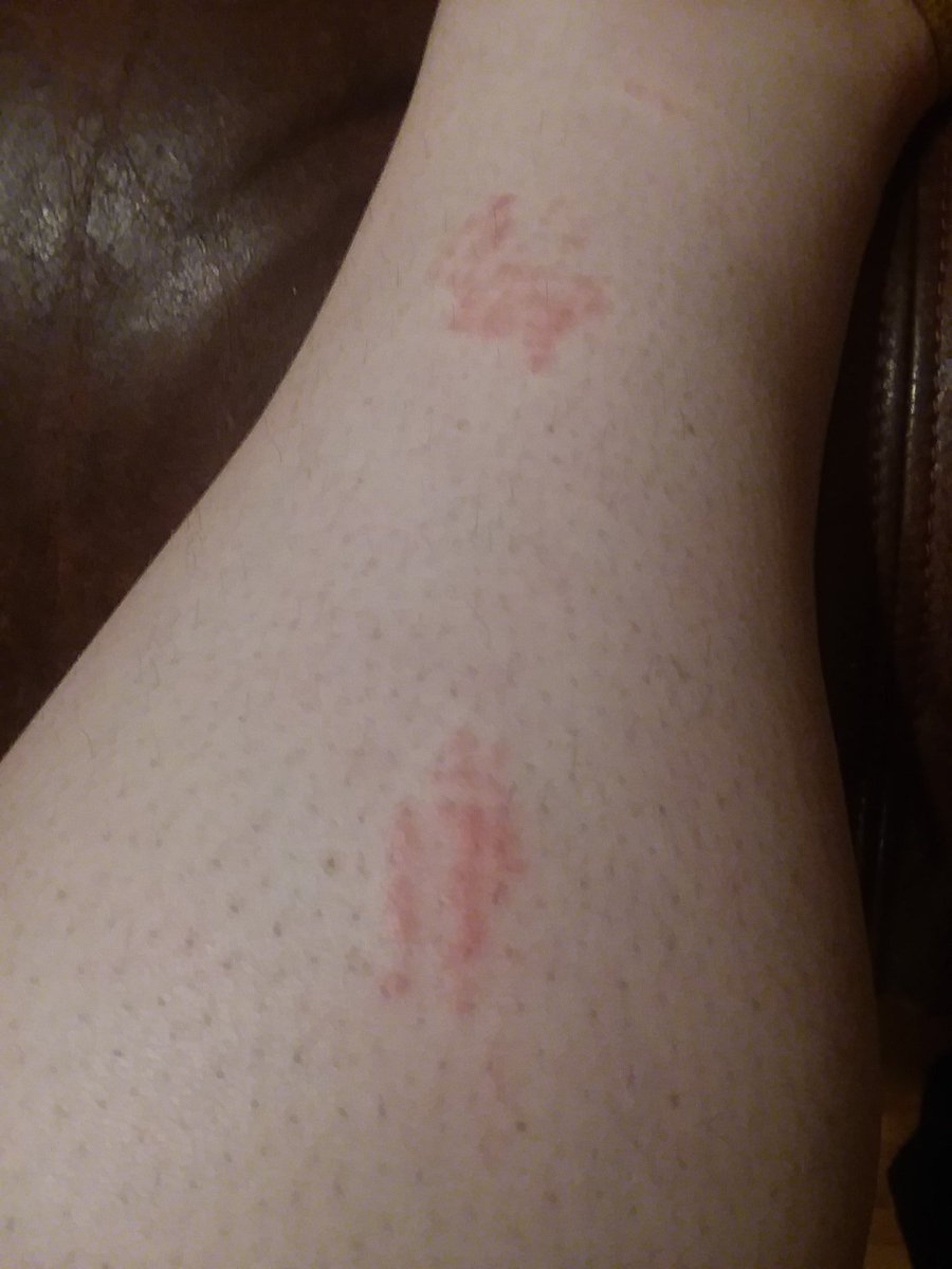 ProjectLove1D's tweet photo. 4 stages of a jelly fish sting
1. Sting
2. Pain
3. Almost goes away
4. Iches like heck https://t.co/q9MoOBYahW
