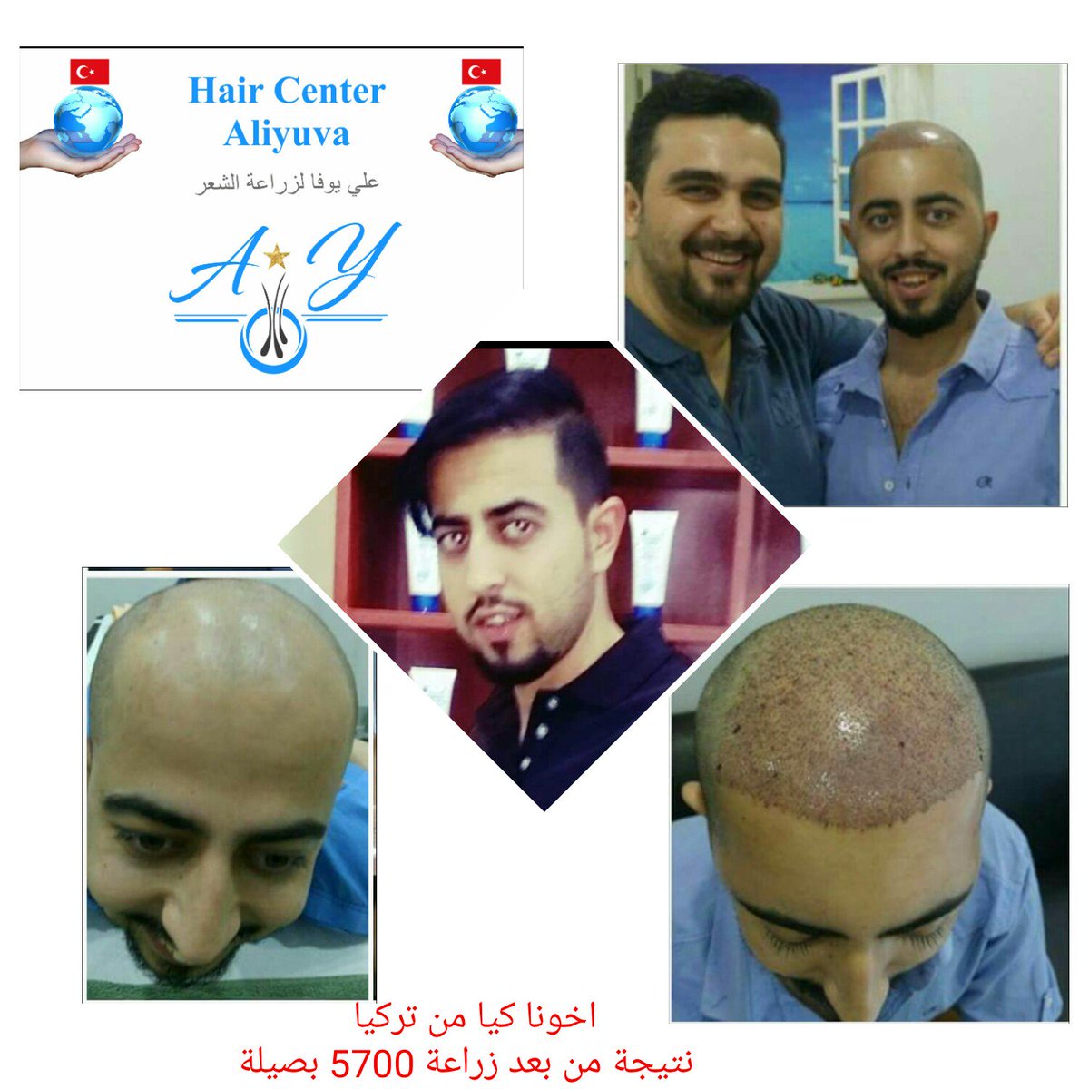 مركز علي يوفا لزراعة الشعر