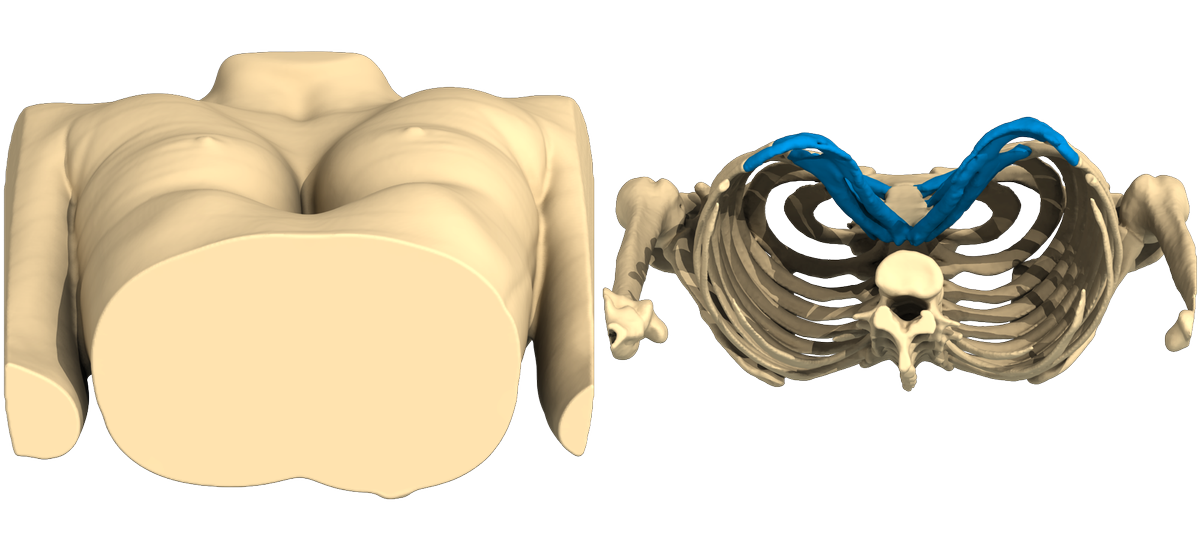 AnatomikM's tweet photo. #PectusExcavatum CaseOfTheWeek
Slim female deep symmetric #Pectus #Excavatum
3D virtual patient's body recon to design custom made implant https://t.co/iunXACDUR0