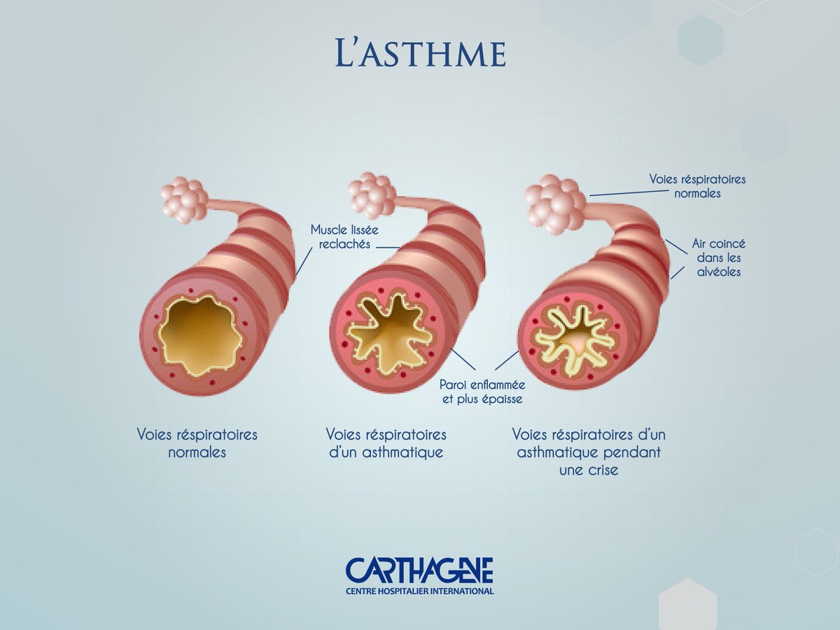 CCarthagene's tweet photo. #ASTHME #IHCT #Tunisie #Carthagene #pneumologie #allergies #Tunisia #Mali #Tchad #algerie #Libye https://t.co/6qUcmwvNXE