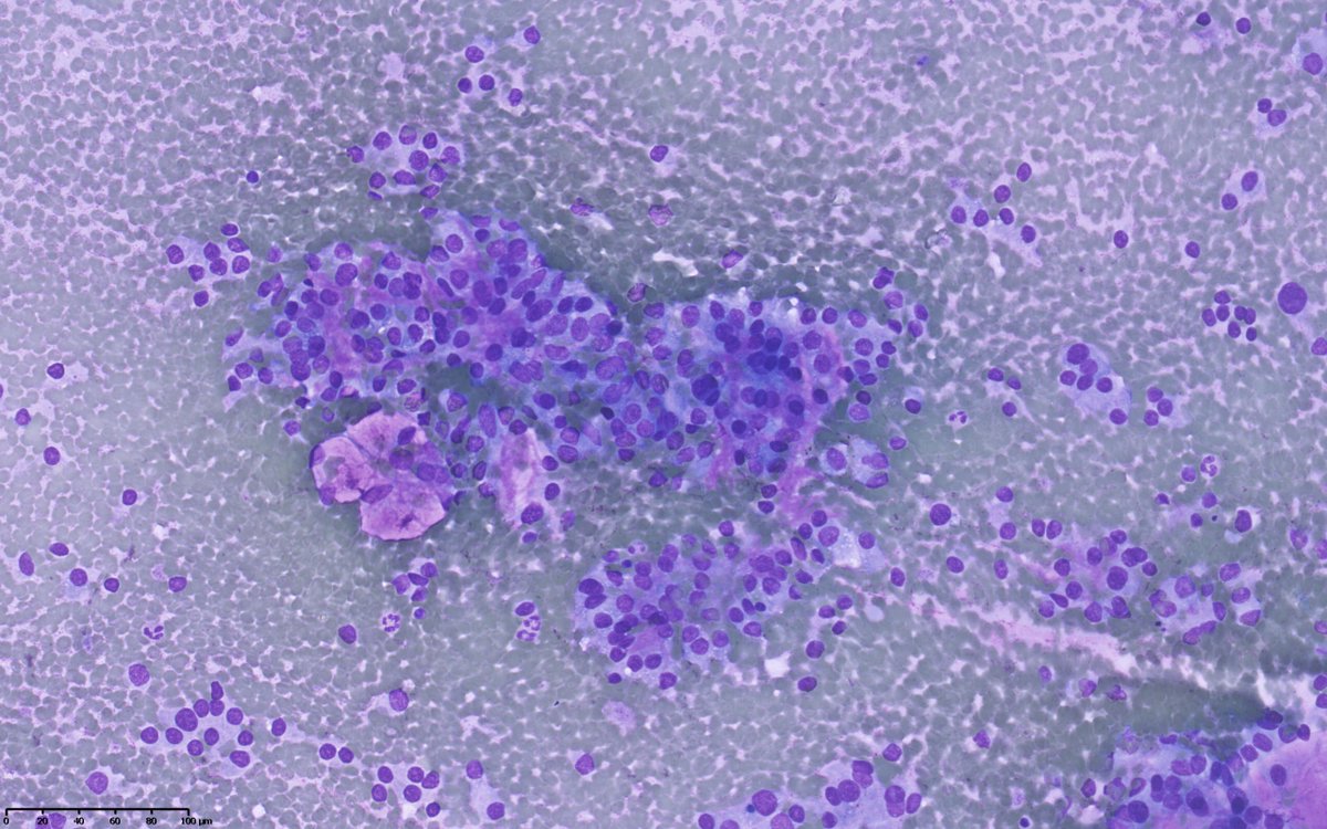 pathologyfinder's tweet photo. Thyroid #FNA. Two questions for you tweeples: which Bethesda class and what do you expect on hysto. #cytopath #FNAfriday #EndoPath https://t.co/7FNjM2haR3