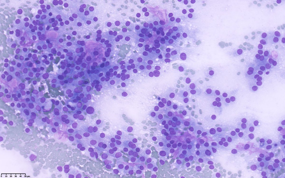 pathologyfinder's tweet photo. Thyroid #FNA. Two questions for you tweeples: which Bethesda class and what do you expect on hysto. #cytopath #FNAfriday #EndoPath https://t.co/7FNjM2haR3